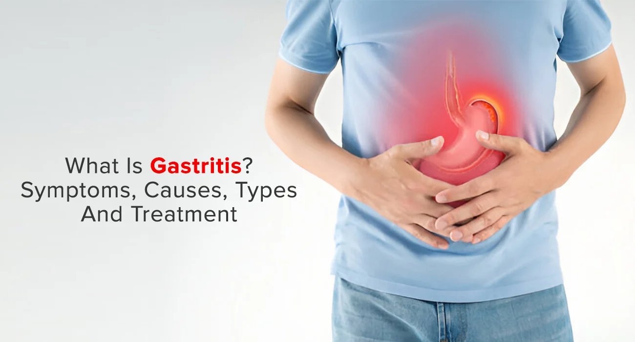 Gastritis Explained: Causes, Symptoms, Types, and Treatment Options