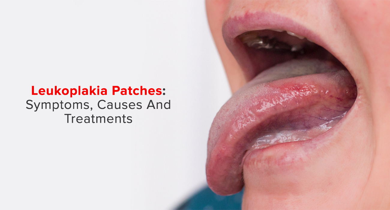 Leukoplakia Patches: Symptoms, Causes and Treatments