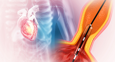 Coronary Artery Disease - Causes, Symptoms and Lifestyle Insights