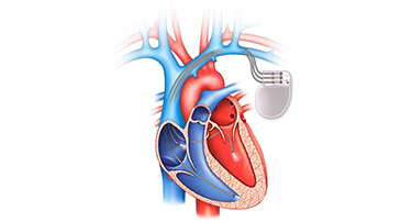 Pacemaker Surgery: Everything You Should Know
