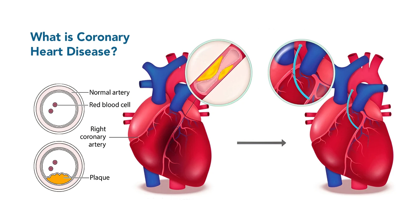 What is Coronary Heart Disease?